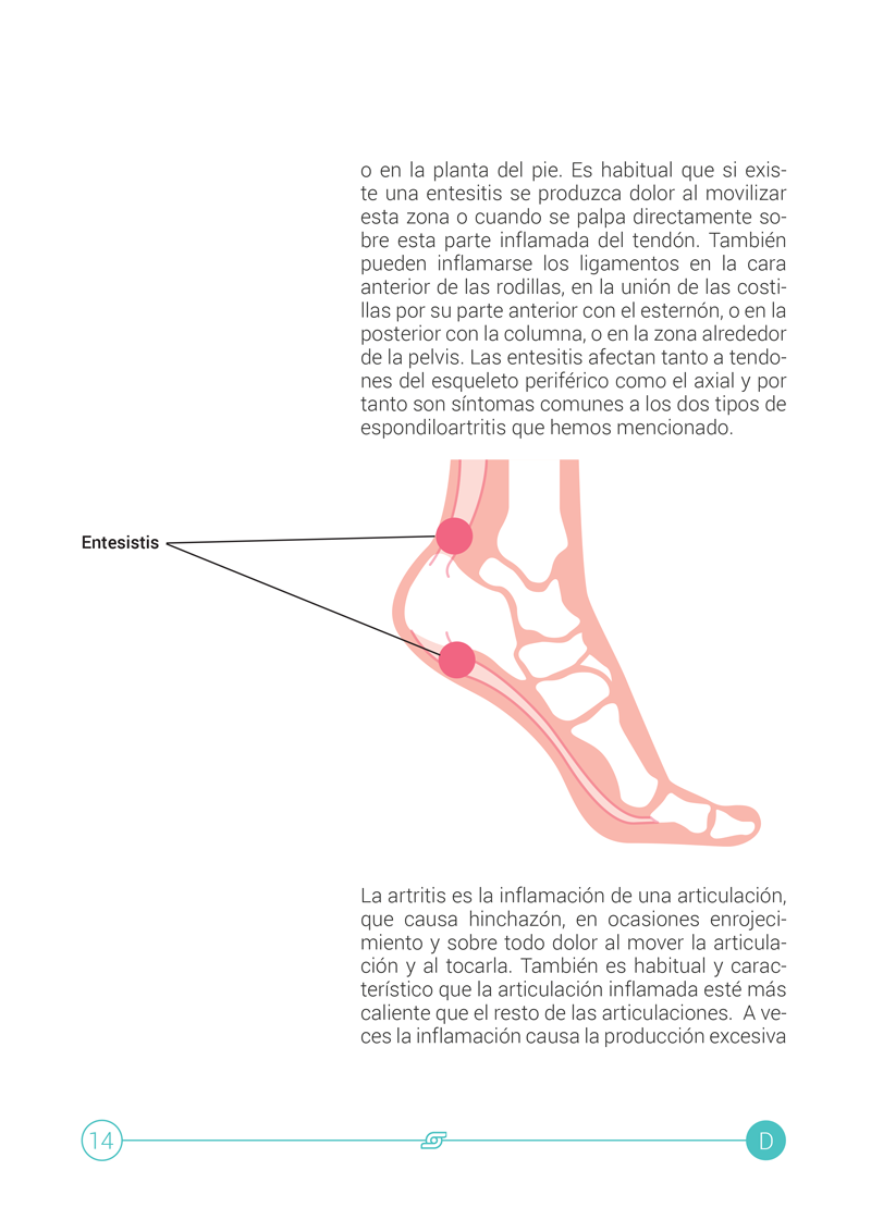 Espondilitis Anquilosante 3